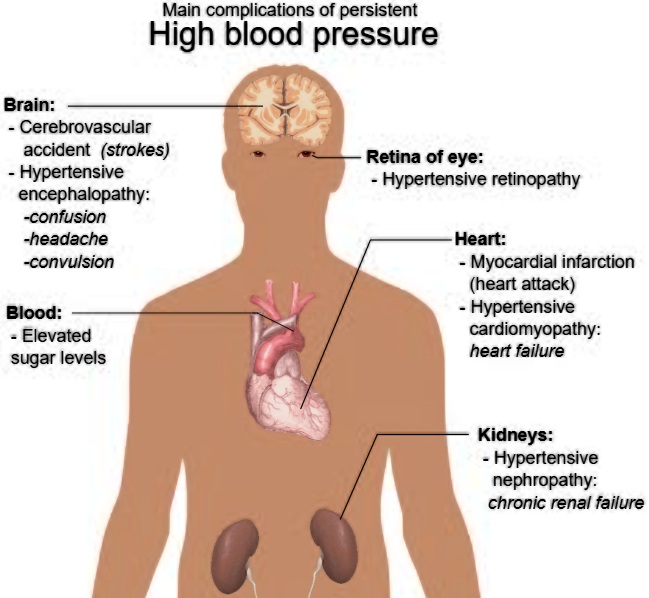 komplikasi berat badan lebih pada hipertensi
